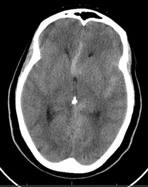 65 year old female collapsed at work with headache, confusion, altered mental status