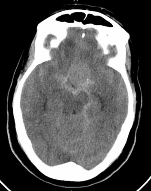 65 year old female collapsed at work with headache, confusion, altered mental status