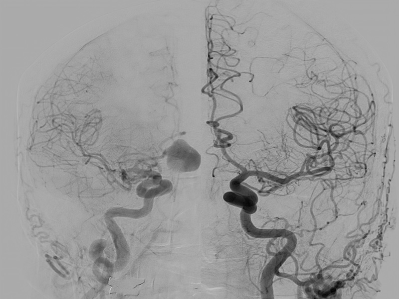 Baseline Angiogram