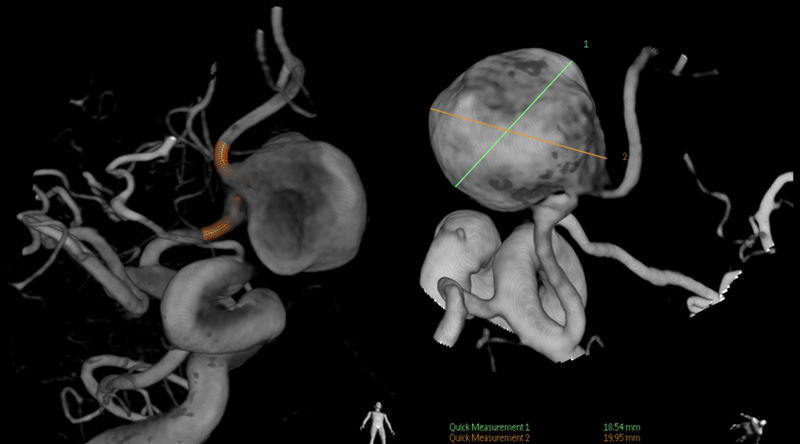 Baseline Angiogram (3D) 