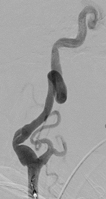Proximal Access