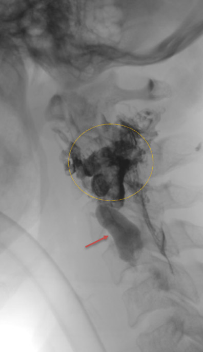 Embolic cast after glue injection