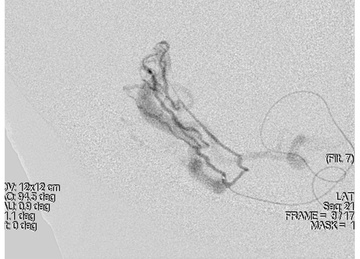 Fistulogram