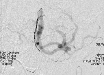 Fistulogram