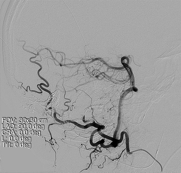 Left Occipital Artery - Final