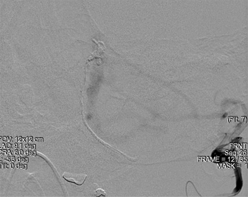 Left Occipital Artery