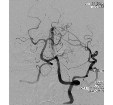Left Vertebral Artery