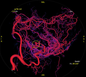 Left Vertebral Artery (Left oblique)