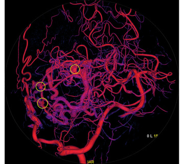 Left Vertebral Artery (Posterior View)