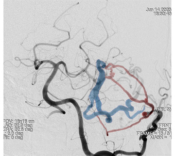 Left Vertebral - Left oblique