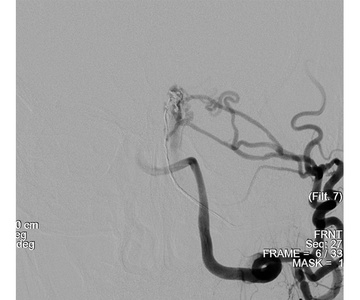 One arterial feeder out minimal venous penetration