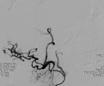 One arterial feeder out minimal venous penetration