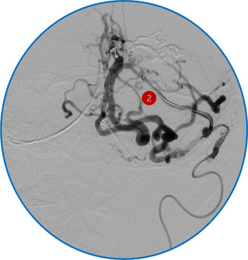 Onyx venous penetration