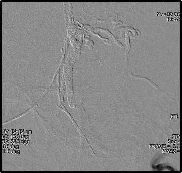 Onyx venous penetration