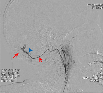 Right Ascending Pharyngeal Artery