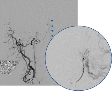 Right Ascending Pharyngeal Artery