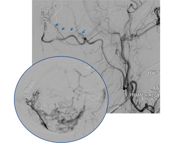 Right Ascending Pharyngeal Artery