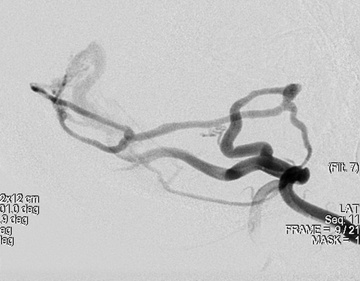 Transarterial embolization 1st Stage