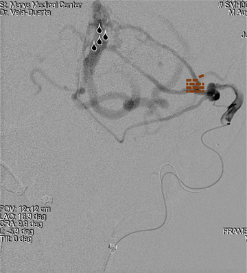 Transarterial embolization 1st Stage