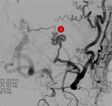 Transarterial embolization - 3rd Stage