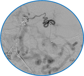 Transarterial embolization - 3rd Stage