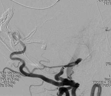 Transarterial embolization - 3rd Stage
