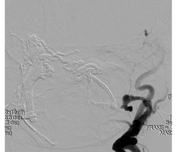 Transarterial embolization - 3rd Stage
