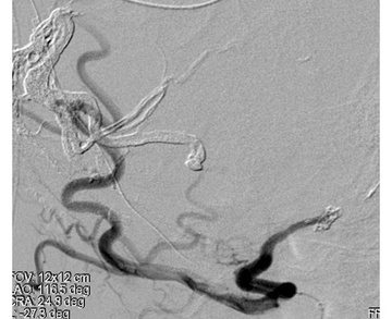 Transarterial embolization - 3rd Stage