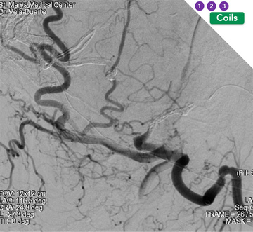 Transarterial embolization - 3rd Stage