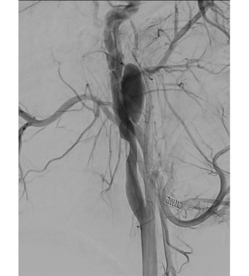 Covered stent