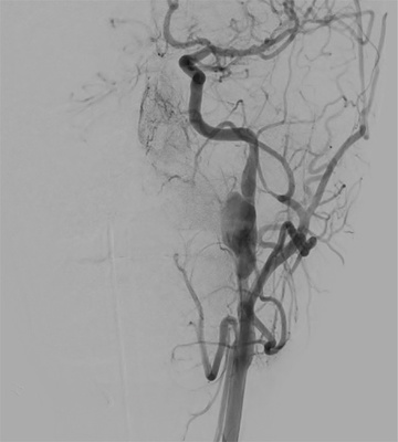 Covered stent