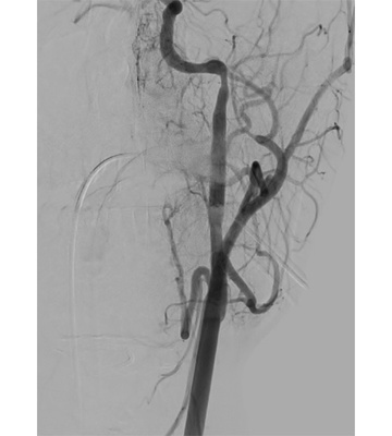 Covered stent