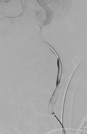 Flow diverting (FD) stent