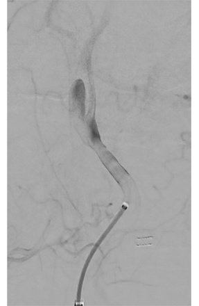 Flow diverting (FD) stent