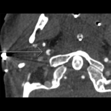Intraluminal Thrombus