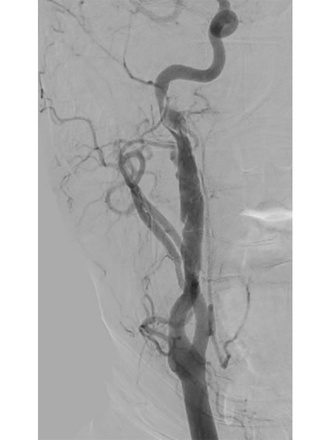 Two FD stents for long segment BCVI
