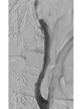 Two FD stents for long segment BCVI