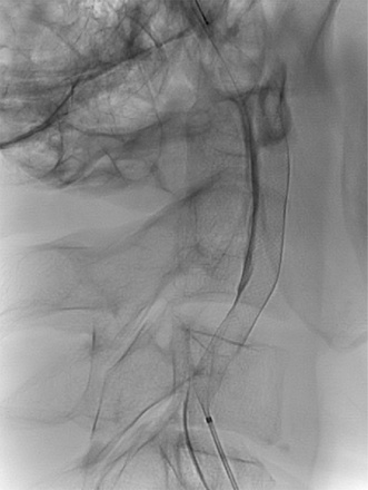 Two FD stents for long segment BCVI