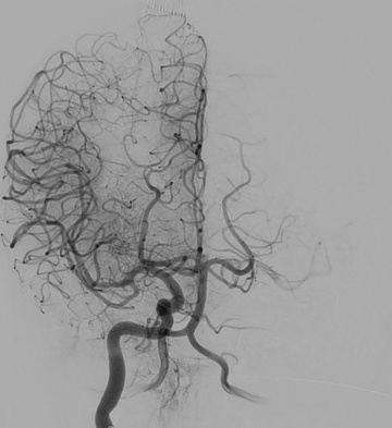 Double Solitaire for ACA and MCA stroke - Figure 6