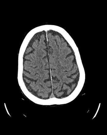 Double Solitaire for ACA and MCA stroke - Figure 9