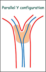 Double stenting technique thrombectomy and PTA treatment for intracranial stenosis - Figure 1