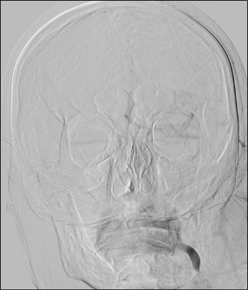 Double stenting technique thrombectomy and PTA treatment for intracranial stenosis - Figure 10