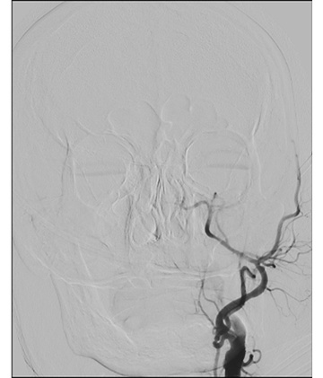 Double stenting technique thrombectomy and PTA treatment for intracranial stenosis - Figure 11