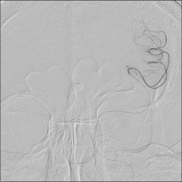 Double stenting technique thrombectomy and PTA treatment for intracranial stenosis - Figure 12