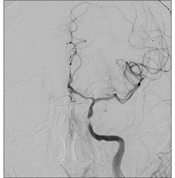 Double stenting technique thrombectomy and PTA treatment for intracranial stenosis - Figure 14
