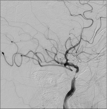 Double stenting technique thrombectomy and PTA treatment for intracranial stenosis - Figure 15