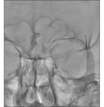 Double stenting technique thrombectomy and PTA treatment for intracranial stenosis - Figure 16