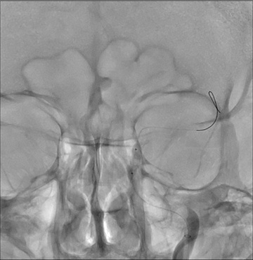 Double stenting technique thrombectomy and PTA treatment for intracranial stenosis - Figure 17