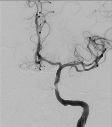 Double stenting technique thrombectomy and PTA treatment for intracranial stenosis - Figure 18