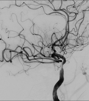 Double stenting technique thrombectomy and PTA treatment for intracranial stenosis - Figure 19